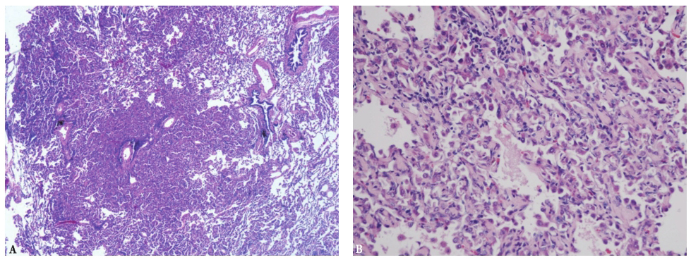 图15胸腔镜肺活检病理表现