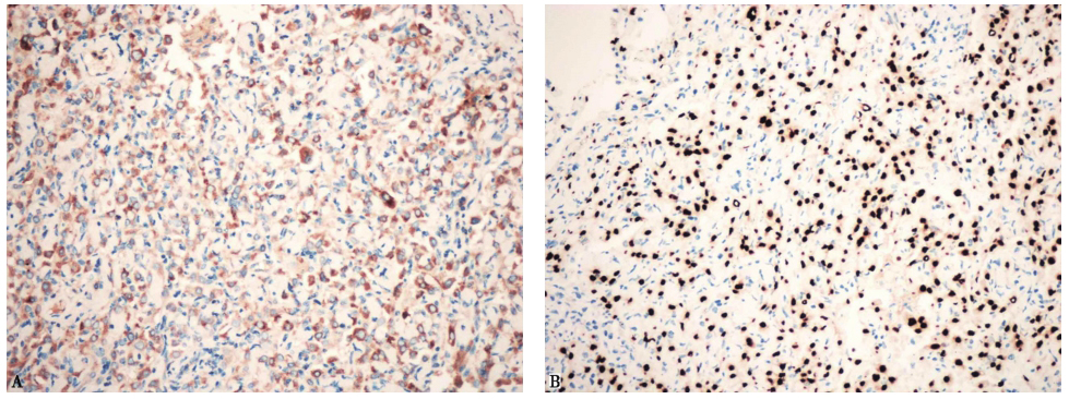 图16胸腔镜肺活检病理免疫组化结果