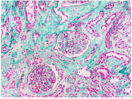 图1马兜铃酸肾病：肾小球无明显病变，肾小管萎缩、消失，裸基底膜形成，肾间质无细胞性硬化（Masson×200）