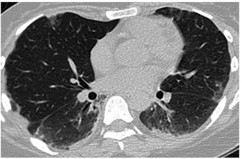 图2伏立康唑治疗1周后复查胸部CT：右侧气胸基本吸收，双下肺实变影及斑片影明显吸收，双肺胸膜下可见磨玻璃影和间质性改变，局限性胸膜增厚