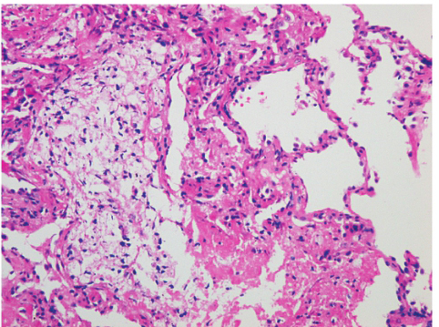 图3右肺下叶后基底段TBLB病理（HE，×400）：见肺泡壁慢性炎症细胞浸润，肺泡腔内见纤维素性渗出，肺泡上皮增生
