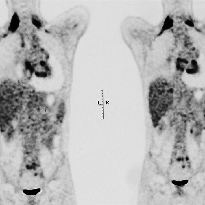 图4PET-CT