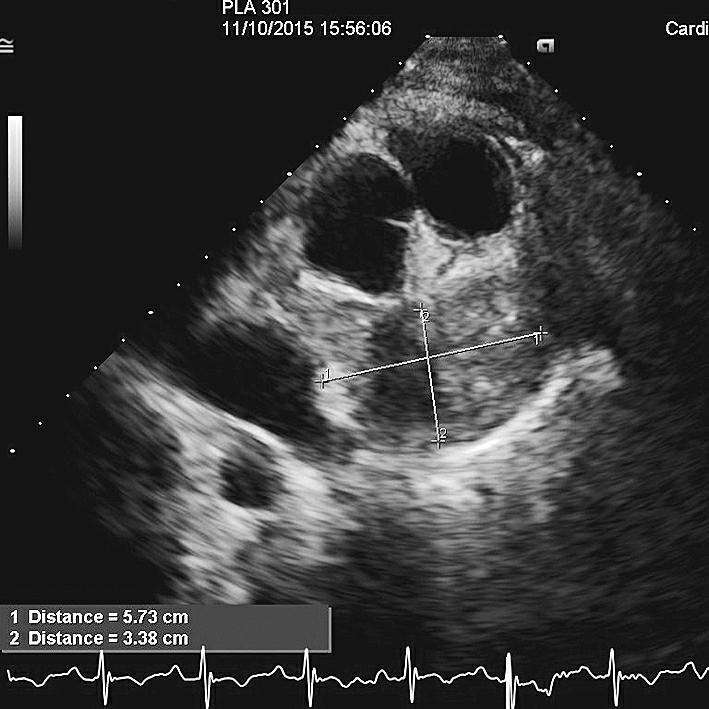 图6化疗后超声心动图