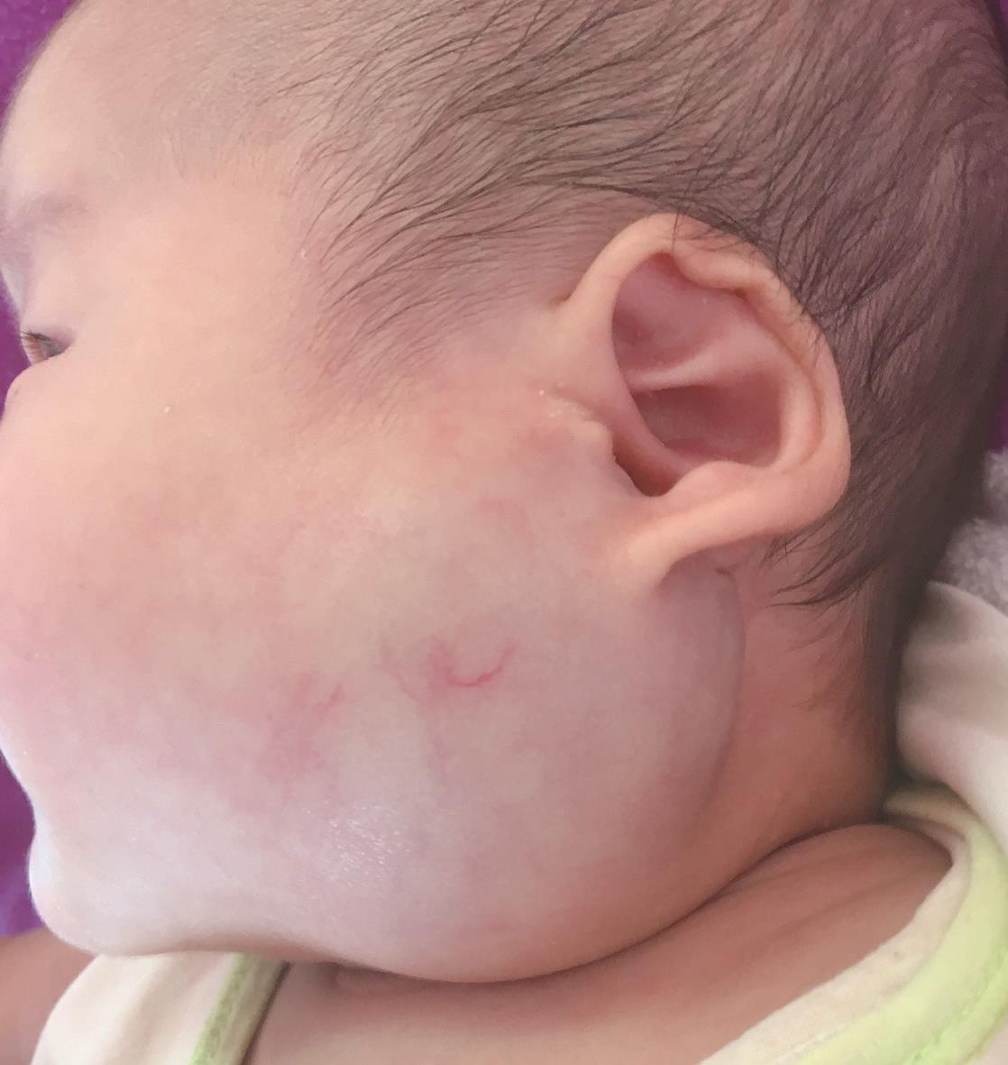 /uploads/image/2025-11-27/153658588图1婴幼儿血管瘤外观.jpg 图1婴幼儿血管瘤外观