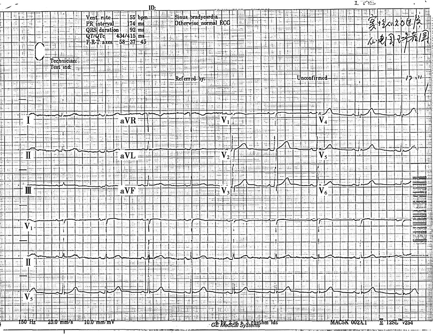 图1患者入院心电图