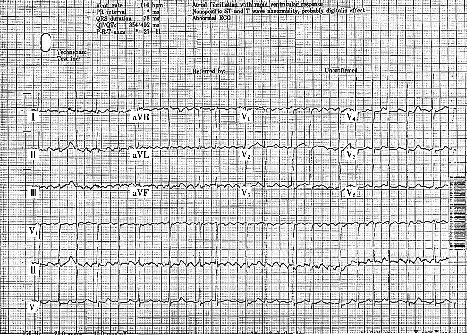 图2患者房颤发作时心电图