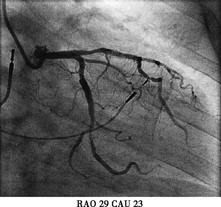 图3初次植入心室电极后冠脉造影-7646134193604608
