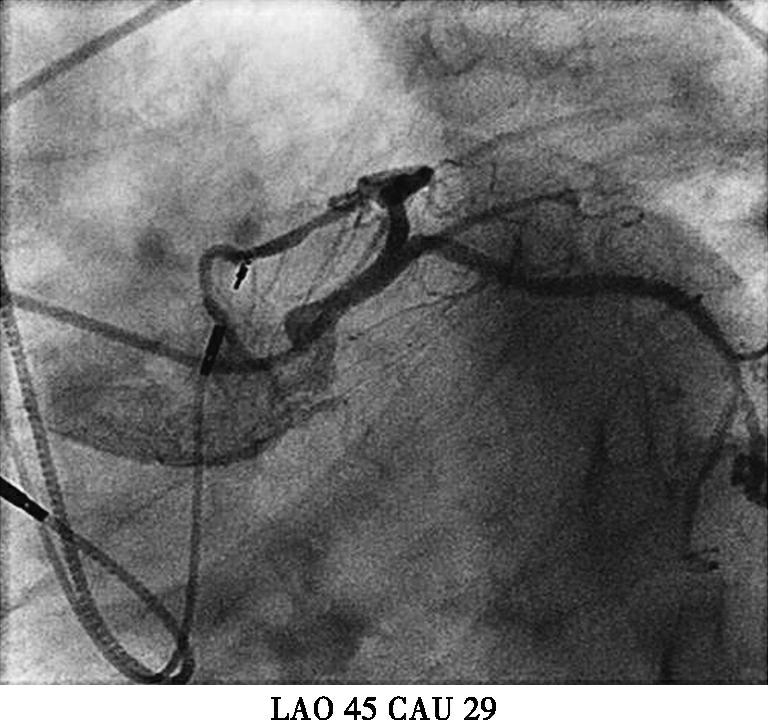 图3初次植入心室电极后冠脉造影-7646135955802112
