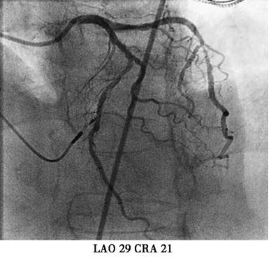 图3初次植入心室电极后冠脉造影-7646139296483328