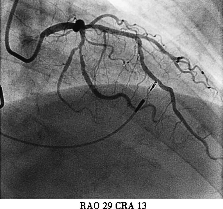 图3初次植入心室电极后冠脉造影-7646139686078464