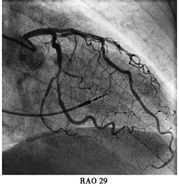 图4重新植入心室电极后冠脉造影-7646135626270720