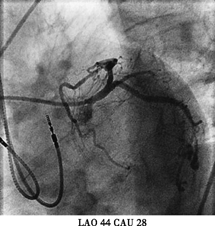 图4重新植入心室电极后冠脉造影-7646137538627584