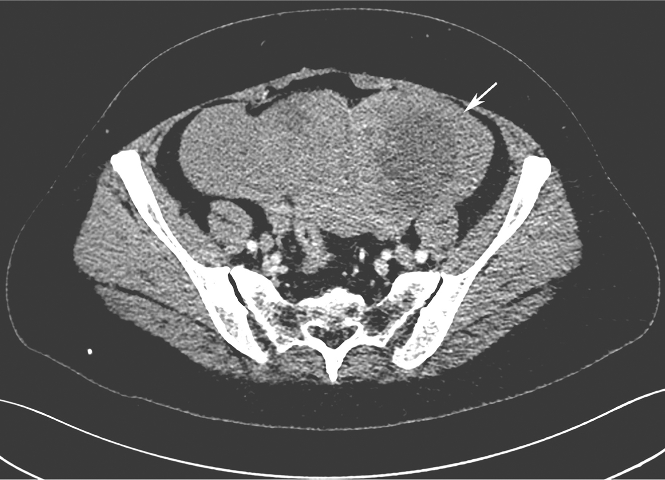 /uploads/image/2025-11-28/134916129图1增强CT示盆腔巨大占位.jpg 图1增强CT示盆腔巨大占位