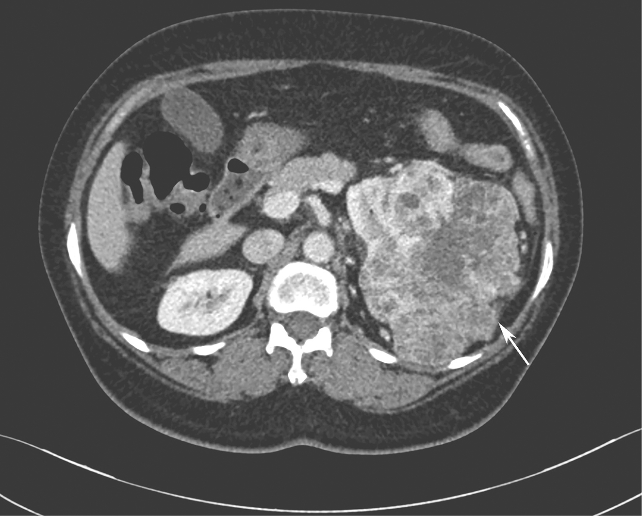 /uploads/image/2025-11-28/134959432图2增强CT示左肾占位病变.jpg 图2增强CT示左肾占位病变