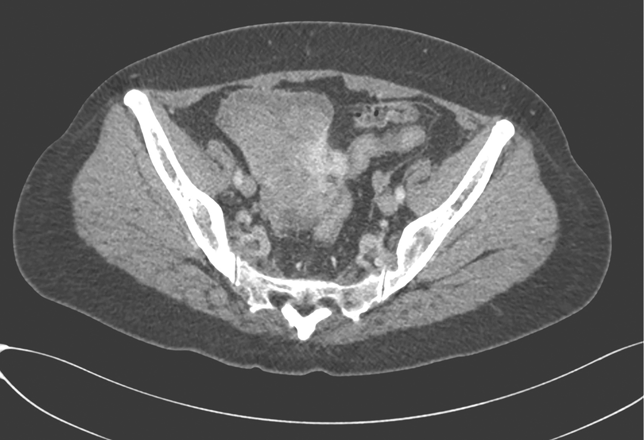 /uploads/image/2025-11-28/135043022图3术前治疗后复查CT示盆腔GIST明显缩小.jpg 图3术前治疗后复查CT示盆腔GIST明显缩小