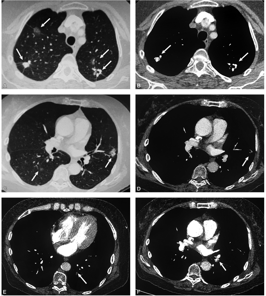 图1胸部薄层CT扫描：双肺上叶尖段多发毛玻璃影和多发陈旧性钙化灶伴粗大毛刺（A、B），右肺下叶背段可见磨玻璃影（C），左肺上叶舌段可见部分实性结节影（D