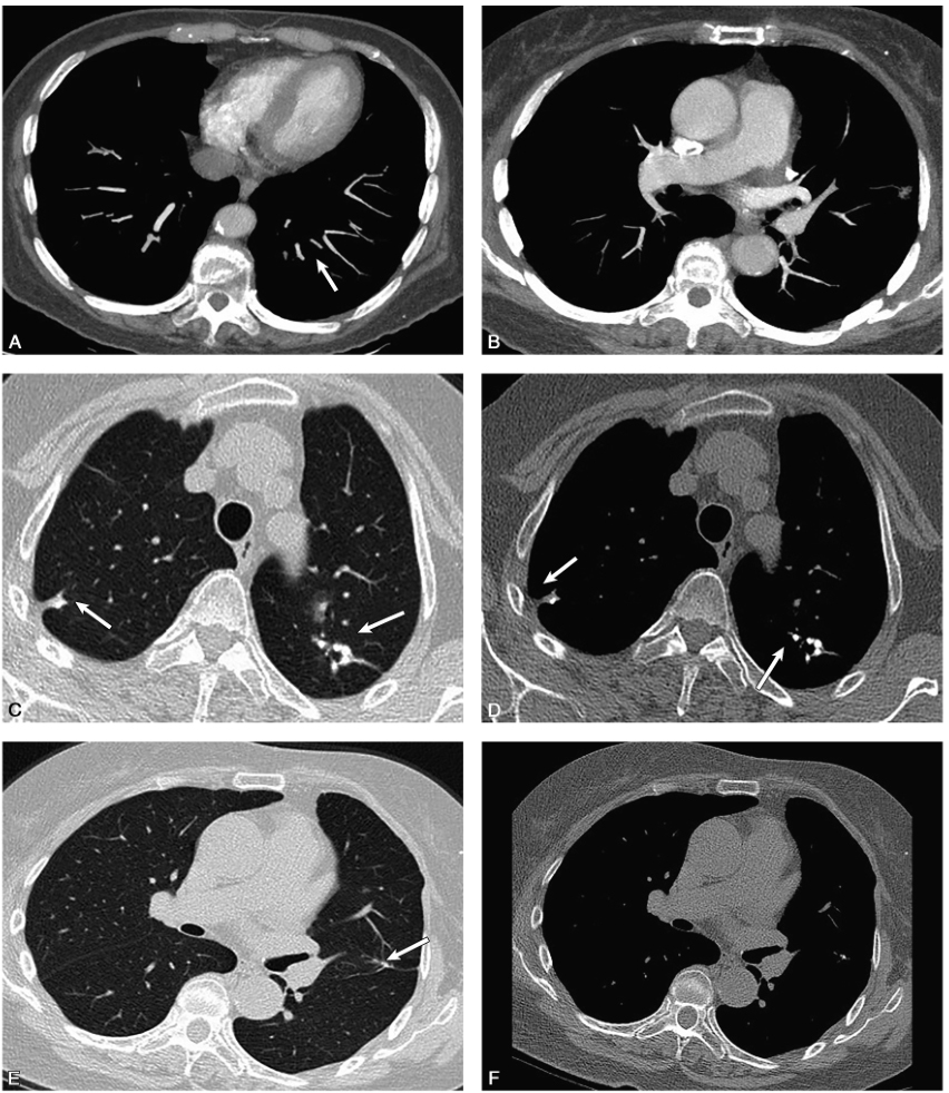 图2患者规律抗凝及厄洛替尼靶向治疗2个月后，复查肺动脉CTA示：原有左下肺动脉血栓基本溶解吸收（A、B）；右肺上叶尖段和右肺下叶背段磨玻璃影基本吸收（C