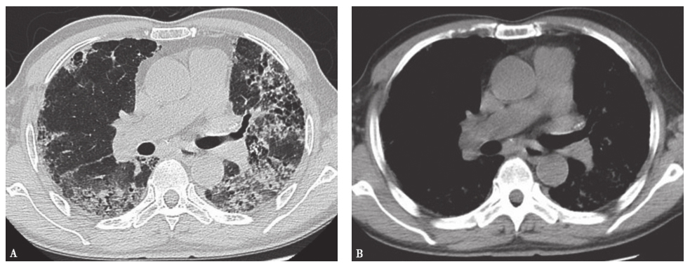 /uploads/image/2025-12-09/105607651图1特发性肺纤维化胸部CT表现.jpg 图1特发性肺纤维化胸部CT表现