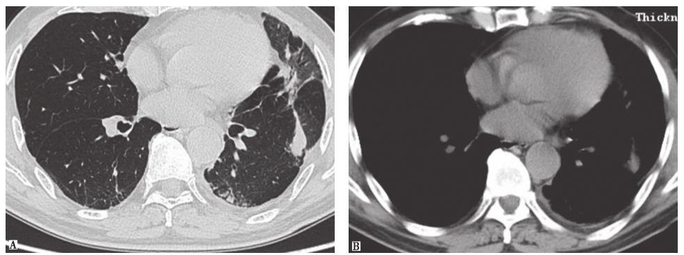 /uploads/image/2025-12-09/105633792图2隐源性机化性肺炎胸部CT表现.jpg 图2隐源性机化性肺炎胸部CT表现