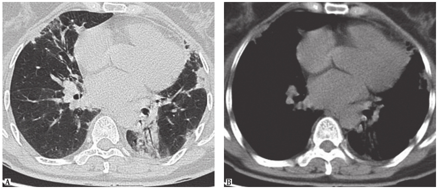 /uploads/image/2025-12-09/105747517图4皮肌炎合并机化性肺炎胸部CT表现.jpg 图4皮肌炎合并机化性肺炎胸部CT表现