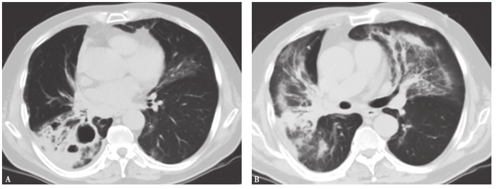 /uploads/image/2025-12-09/105811648图5放射性肺炎胸部影像学表现.jpg 图5放射性肺炎胸部影像学表现