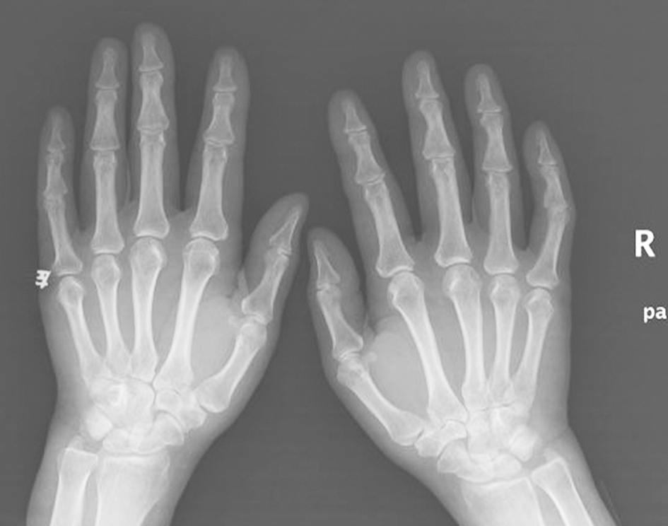 /uploads/image/2025-12-09/110100814图7双手正位X线片.jpg 图7双手正位X线片
