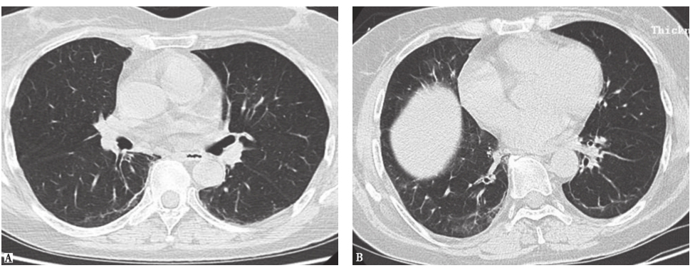 /uploads/image/2025-12-09/110226690图86个月后复查胸部HRCT表现.jpg 图86个月后复查胸部HRCT表现