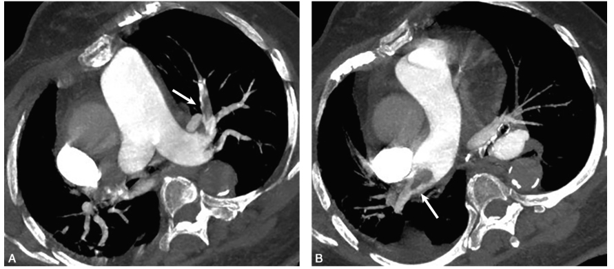图1肺动脉CTA：左肺上叶肺动脉充盈缺损（A）；右肺动脉主干及右肺中间干动脉充盈缺损（B）（白箭），胸主动脉蛋壳样钙化