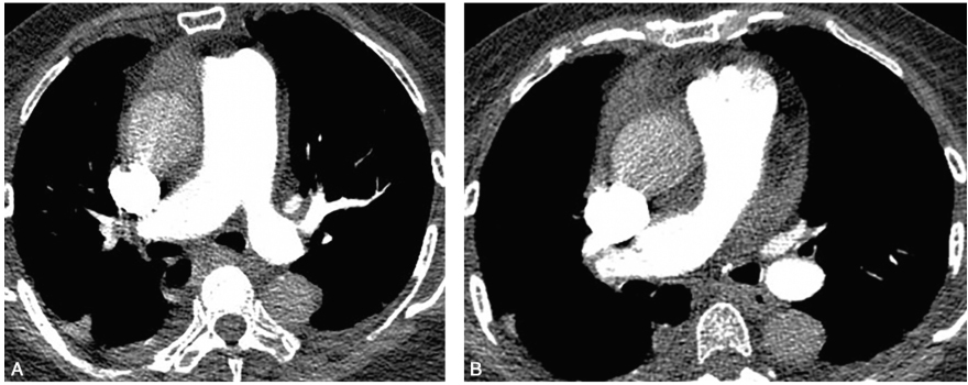 图4抗凝1个月后复查肺动脉CTA：左肺上叶肺动脉充盈缺损消失（A）；右肺动脉主干及右肺中间干动脉充盈缺损消失（B）