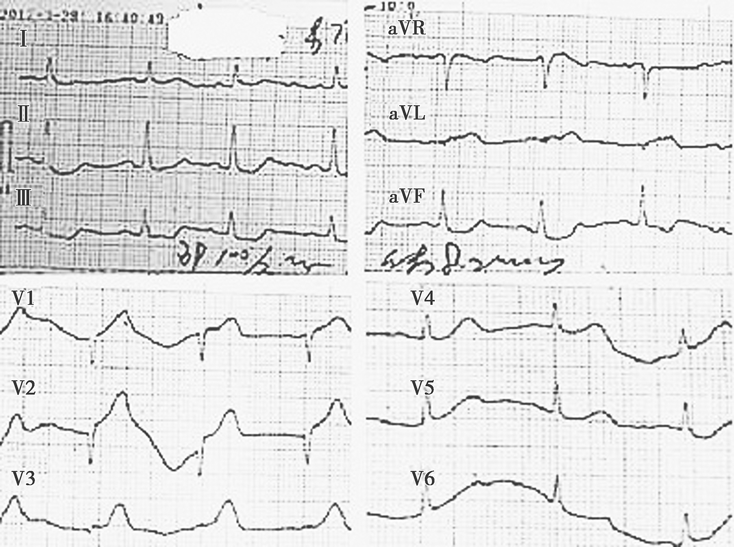 图1发病时心电图