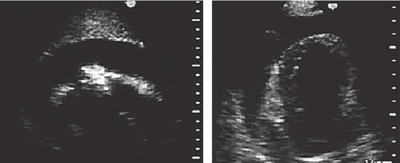 图3入院时超声心动图