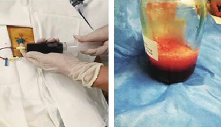 图4第一次心包穿刺所见