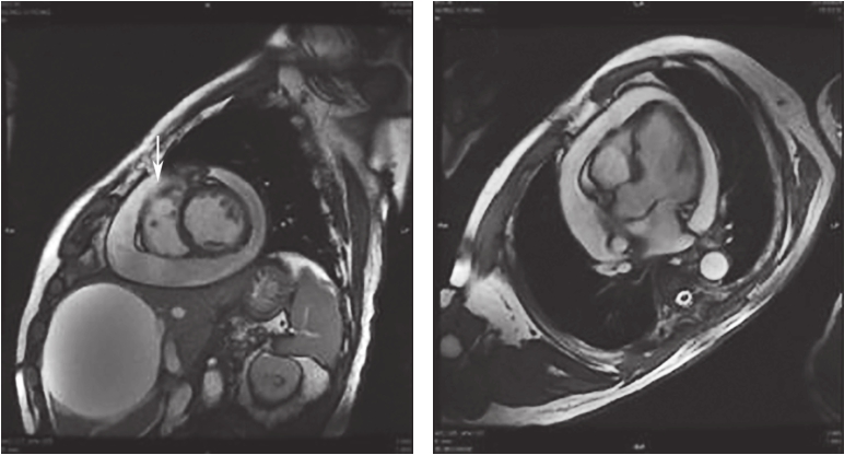 图5心脏增强磁共振成像所见