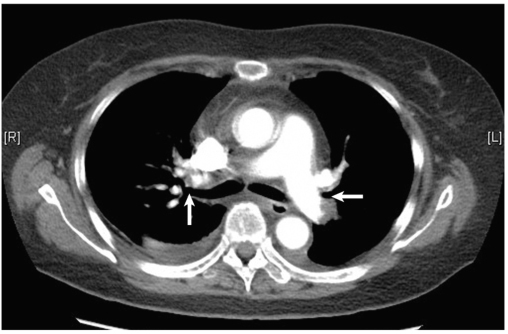 图1肺动脉CTA显示双侧肺动脉多发充盈缺损（白箭）